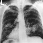 Chest-XRay-publicdomain